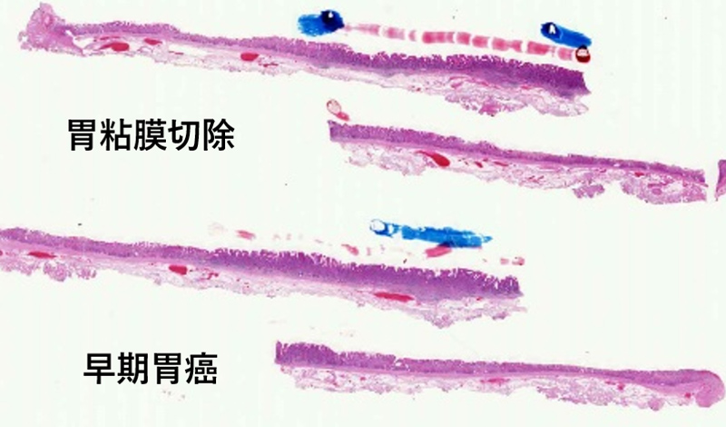 早期胃癌