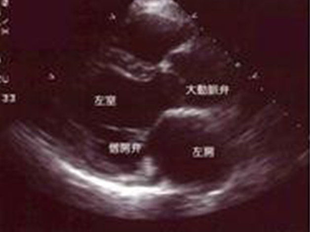 心臓超音波検査
