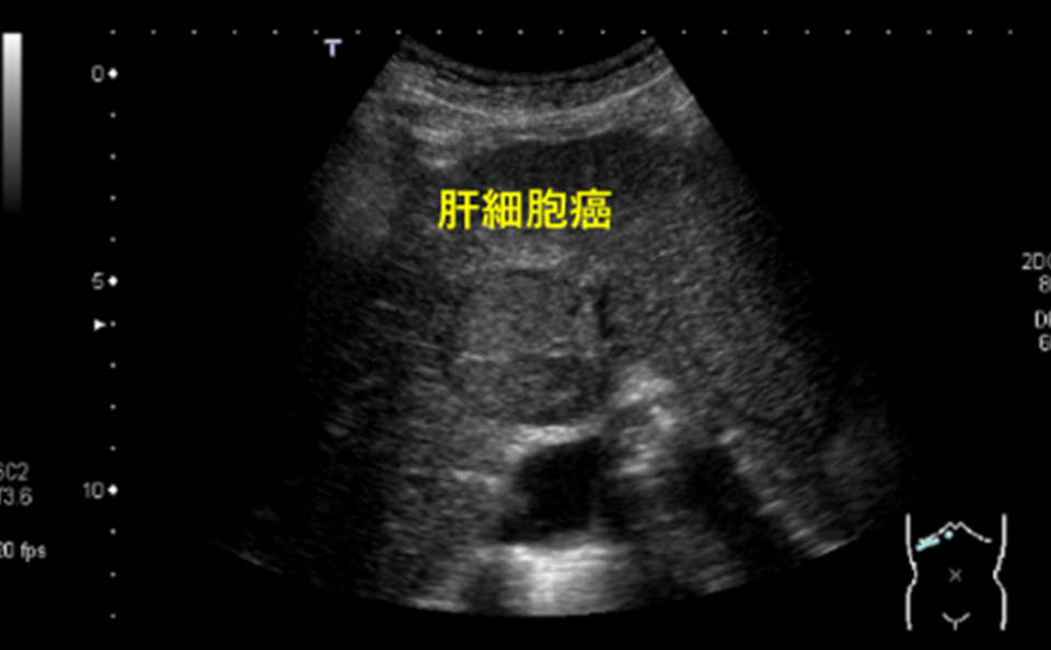 腹部超音波検査